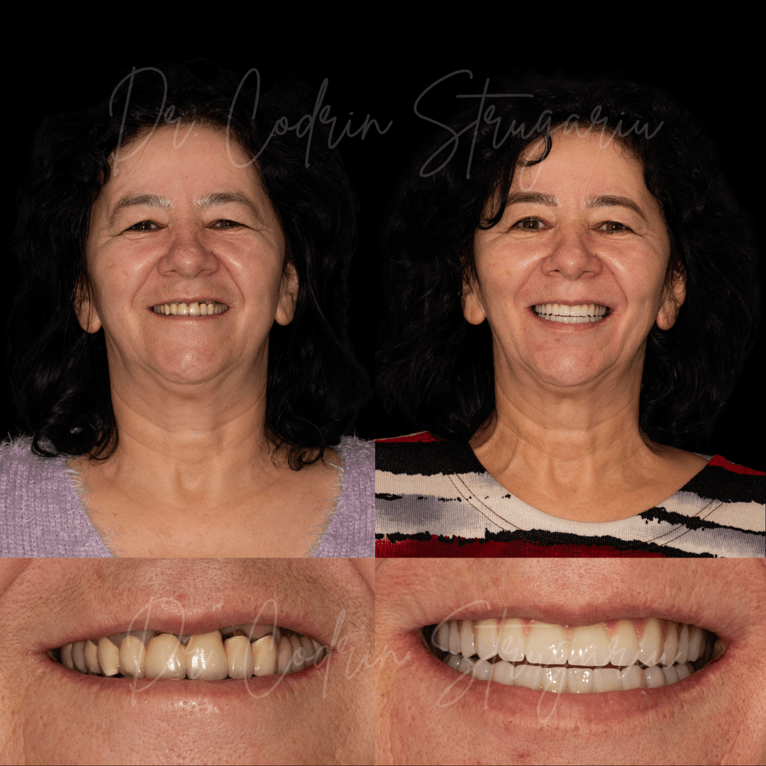 Reabilitare dentară completă pe implanturi — caz clinic înainte și după tratament, Dr. Codrin Strugariu Cluj-Napoca